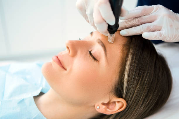 Is micro needling procedure beneficial for acne