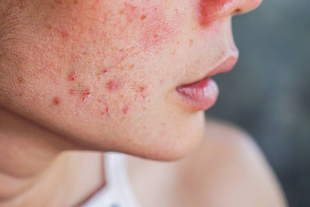 The Battle Against Acne: Effective Treatment and Prevention Strategies