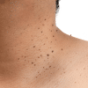 skin tag