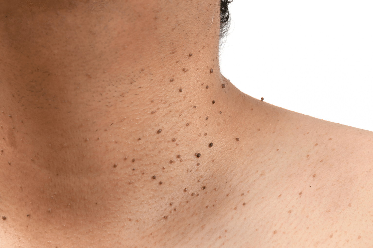 How to Remove Skin Tags Naturally: Home Remedies That Really Work